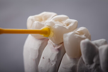 Dental Art, Smile design, Teeht