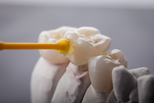 Dental Art, Smile design, Teeht