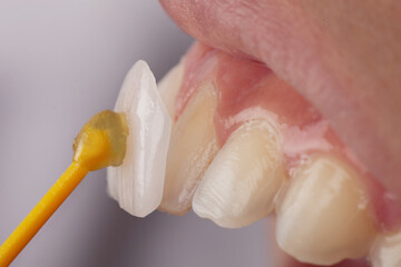close up of teeth