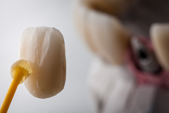 Dental Art, Smile design, Teeht