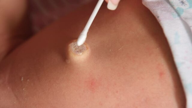 Umbilical cord of a newborn baby. Treatment of the navel with hydrogen peroxide and a cotton swab. Healing.