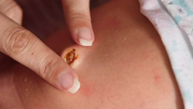 Umbilical cord of a newborn baby. Women's hands open the navel for examination. Healing. Close up