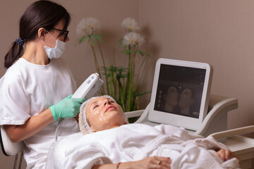 Lifting by ultrasound using a special cosmetology device. Smoothing wrinkles on the face with ultrasound