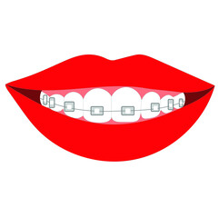 Woman's smile with braces on her teeth in vector. Stock illustration isolated on white background. Medical installation of braces by an orthodontist for fusion of bite and teeth alignment. 
