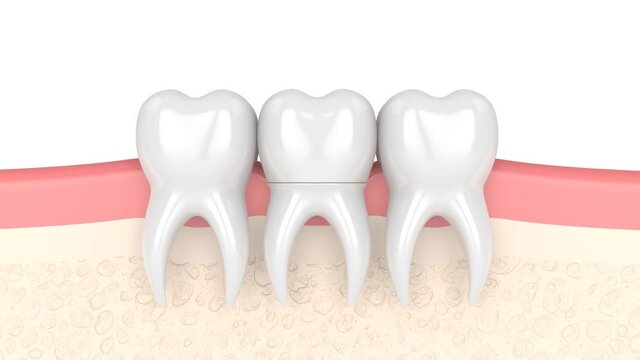 Gums with dental composite crown filling
