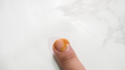 The finger is wound with blood