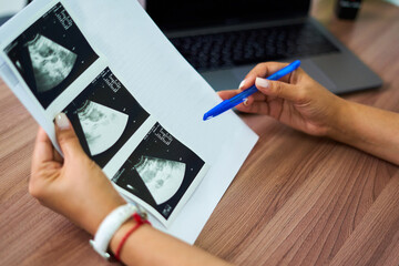The doctor holds an ultrasound scan of a pregnant girl in the hand