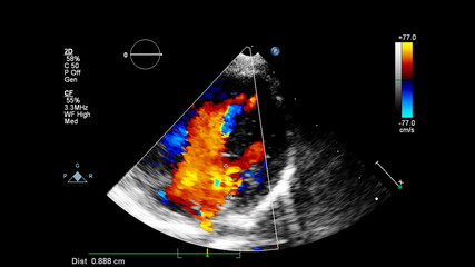 Image of the heart during transesophageal ultrasound with Doppler mode.