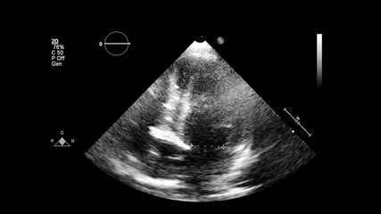 Image of the heart in gray-scale mode during transesophageal ultrasound.