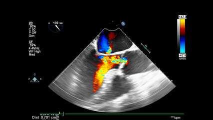 Image of the heart during transesophageal ultrasound with Doppler mode.