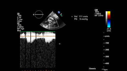 Image of the heart during transesophageal ultrasound with Doppler mode.