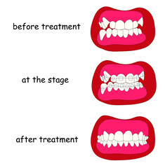 The effect of braces is a visual demonstration by an orthodontist before the procedure, during treatment and after the procedure is completed. Stock vector illustration isolated on white background.