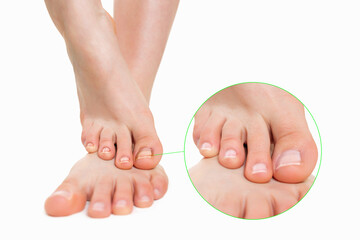 Female feet placed one on top of the other, with nail fungus disease. Zoomed image of the nail, the...