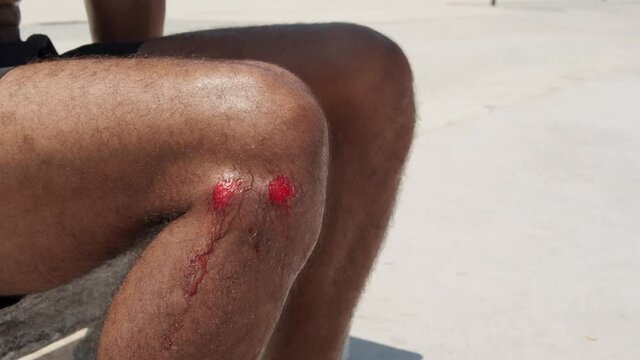 The guy got abrasions after an unsuccessful fall from the skateboard. A wet guy on the shore examines an injured knee.