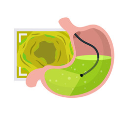 Gastroscopy. Endoscopy and digestive problems. Hose with camera. Procedure with internal organs. Cartoon flat illustration. Medical Visual inspection of stomach. Scan of monitor with screen