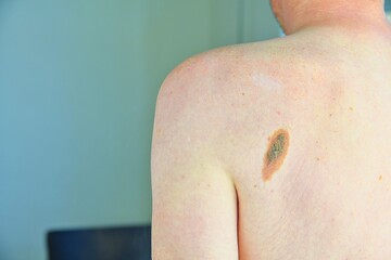 Fototapeta premium Pigmented nevus. Big flat benign brown birthmark on man back. Close up picture of dangerous brown nevus on human skin - melanoma