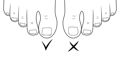 Right to cut toenails. Ingrown toe nail