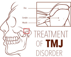 Obraz premium Vector illustration of treatment of tmj disorder