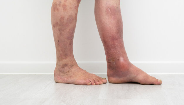 Close up photo of legs with lymphostasis and psoriasis.