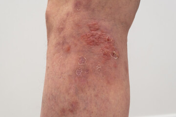 close up photo of leg with psoriasis.