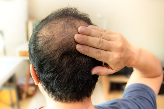 the backside of a man suffering from hair loss.
