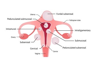 Uterine fibroids, noncancerous growths of the uterus. Different locations inside womb subserosal, submucosal, pedunculated, cervical. Uterus anatomy and fibroids are marked with lines. 
