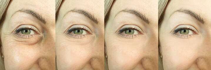 woman face wrinkles before and after treatment, collage,