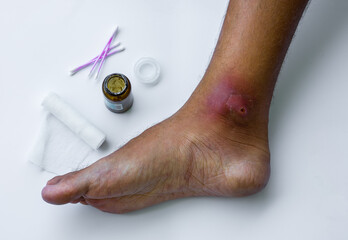 Abscesses form after bacteria. Infected purulent open wound on the man's foot. Festering wound care process.