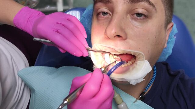 The dentist works with tools with a filling. Caries treatment, restoration of a decayed tooth, professional help, root canal filling. Mouth pain relief concept
