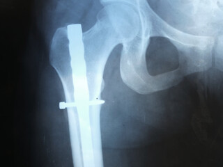 This stock photo shows the X-ray of a femur after surgery with the addition of an iron needle after...