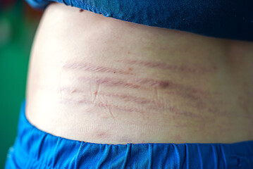 Close-up of stretch marks on the back. Rear view. The concept of skin elasticity disorders during puberty. Stretch marks after hormone treatment