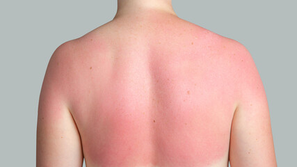 Sunburn. The red back of a woman after a sunburn.