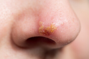 Closeup of Nose with herpes simplex infection and blisters