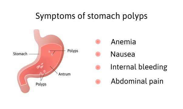 Symptoms of gastric polyps. pedunculated and flat-based polyp. Antrum. Anemia, nausea. Medical vector illustration marked with lines