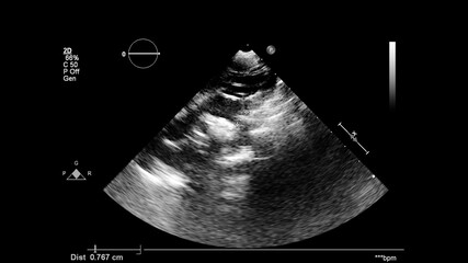 Image of the heart in gray-scale mode during transesophageal ultrasound.