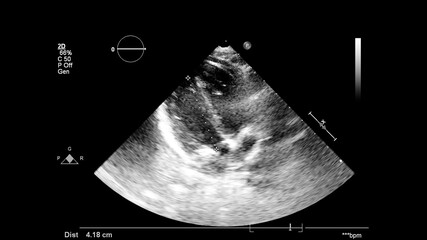 Image of the heart in gray-scale mode during transesophageal ultrasound.