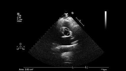Image of the heart in gray-scale mode during transesophageal ultrasound.