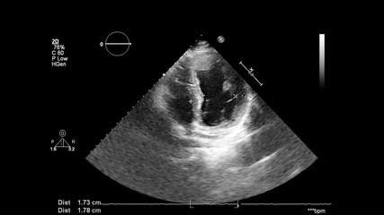Image of the heart in gray-scale mode during transesophageal ultrasound.