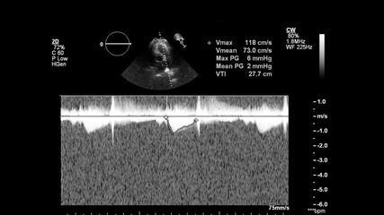 Image of the heart in gray-scale mode during transesophageal ultrasound.