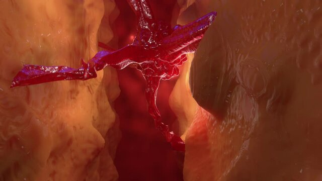 3D Animation of a  Cancer Tumor or Metastasis growing on healthy Tissue.