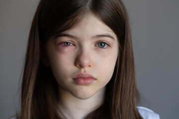 The young girl is allergic. Conjunctivitis, lacrimation, red eyes
