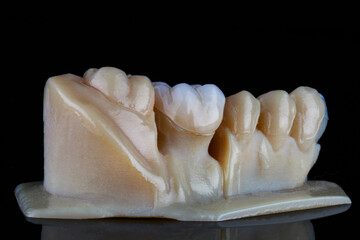 zircon crown on a mini model made on a 3D printer