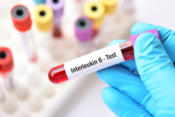 Fototapeta premium Blood sample tube for interleukin 6 or IL-6 test, Pro-inflammatory cytokine and anti-inflammatory myokine