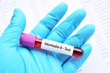 Obraz premium Blood sample tube for interleukin 6 or IL-6 test, Pro-inflammatory cytokine and anti-inflammatory myokine