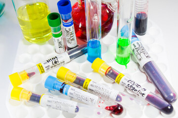 H1N1, Covid-19, Hepatitis C, Tuberculosis and Staphylococcus viruses blood tests in the tubes, laboratory diagnostics