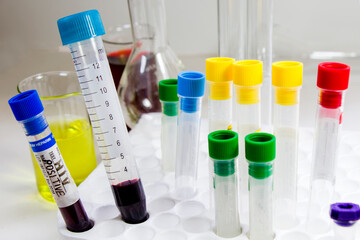 Hiv and aids infection blood test sample, diagnoses and laboratory chemical liquid elements