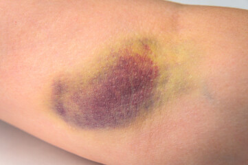 Closeup of a very large bruise on a human arm, after a botched blood draw