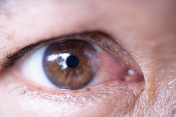 Close-up of cataract eyes