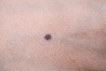 
Moles are black spots that occur on the body.