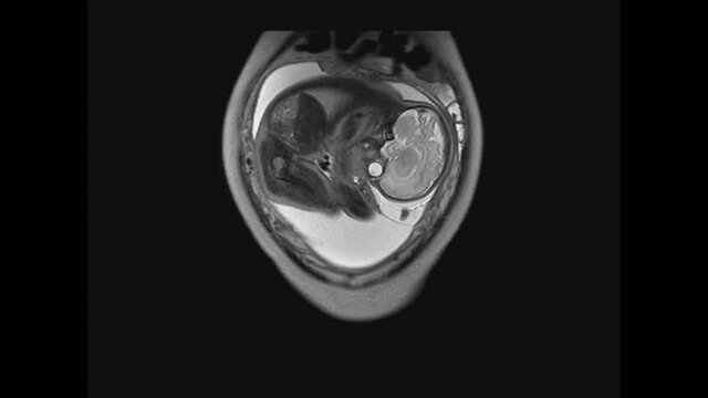 MRI Imaging exam during pregnancy